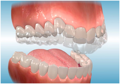 ortodontik aparatlar buket ortodonti